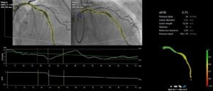 FAST-III-Studie zeigt Nicht-Unterlegenheit von CAAS vFFR gegenüber invasiver drahtbasierter FFR